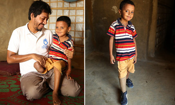 A prosthesis for Anowar